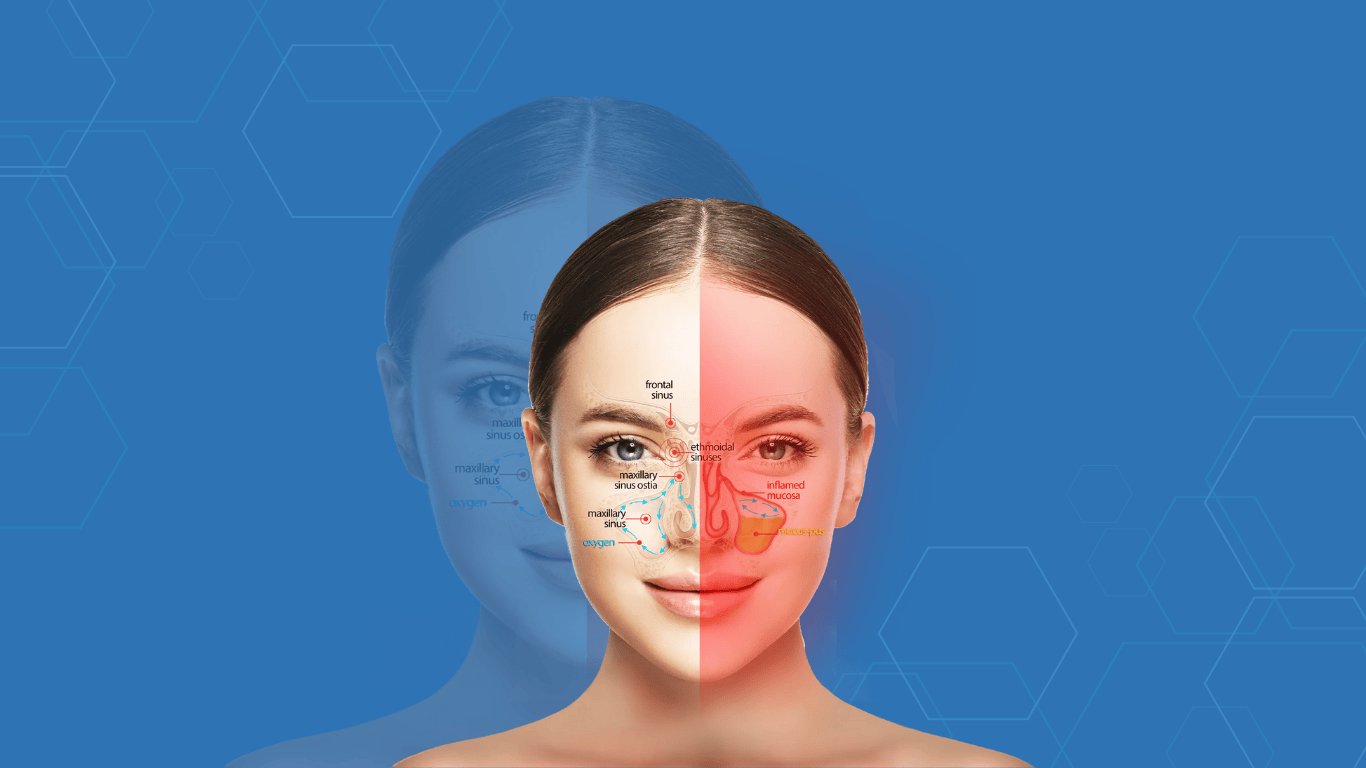 Sinusitis: why distinguishing between inflammatory forms (including non-allergic) and purulent infection is essential